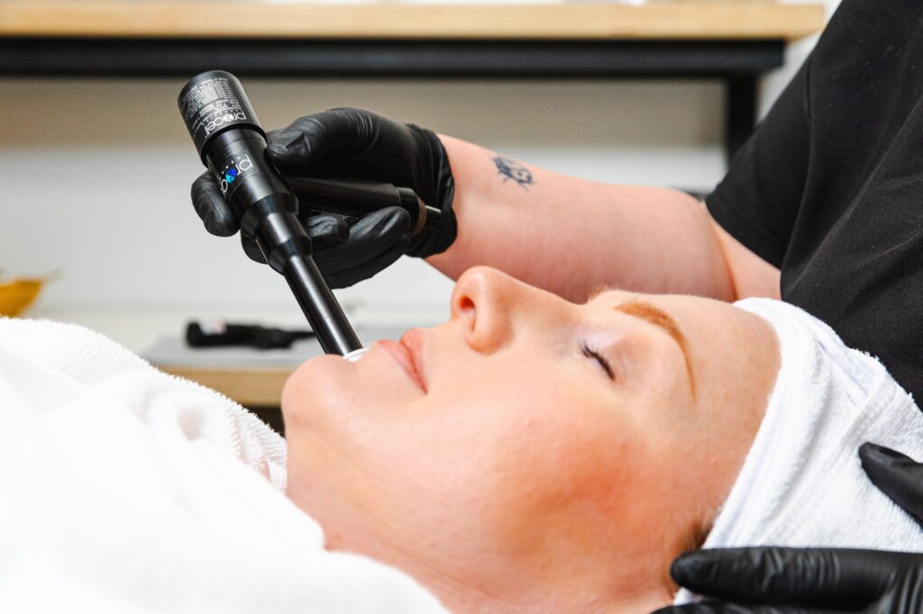 Close-up of a patient receiving Procell microchanneling treatment, which differs from microdermabrasion and microneedling.